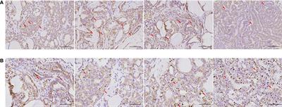 Mitochondrial Respiration Inhibition Suppresses Papillary Thyroid Carcinoma Via PI3K/Akt/FoxO1/Cyclin D1 Pathway